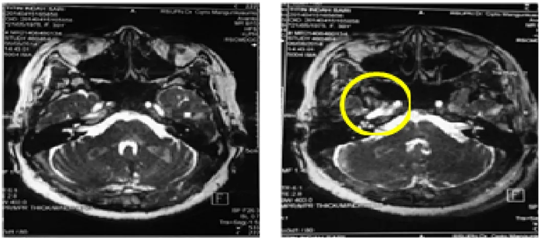 Gambar 2. MRI Otak Pasien 2