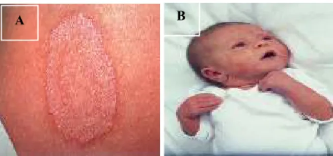 Gambar  1.    Kerokan  Permukaan  Kulit  (Lesi)  A. Kulit yang Terinfeksi Cendawan;  B