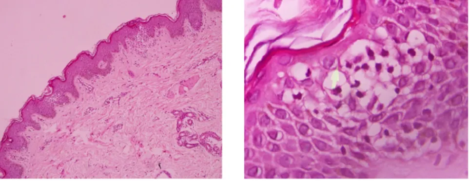 Gambar 15-16 gambaran histopatologis kasus 3: Pwarnaan HE tampak celah subkorneal, spongiosis dan infiltrat eosinofil