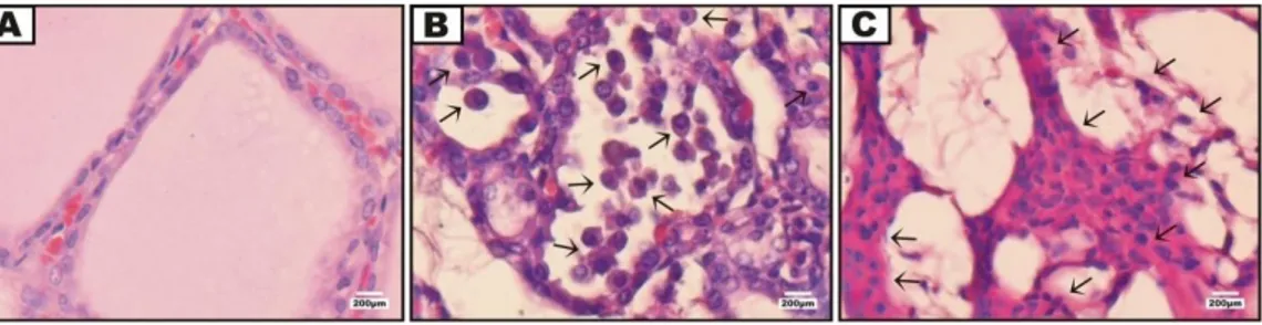 Gambar 3.   Infiltrasi sel mononuklear pada jaringan tiroid (pewarnaan hematoksilin-eosin)