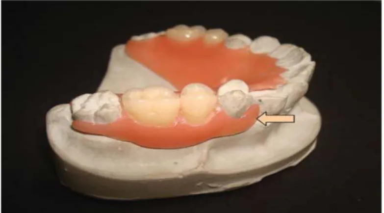 Gambar 3. Peningkatan estetika karena ketiadaan claps berbahan logam       (Sumber: www.scribd.com/Flexible dentures A fl-exible option to treat edentulous) 
