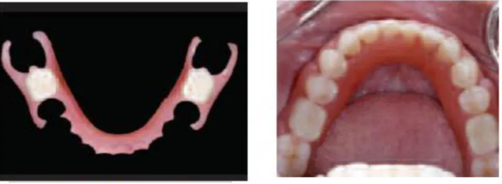 Gambar 5. A. All Valplast sebagian adalah tissue-borne dan fleksibel yang  memberikan kenyamanan maksimum pada  pasien