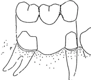 Gambar 6: Extracoronal retainer 2) Partial Veneer Crown Retainer