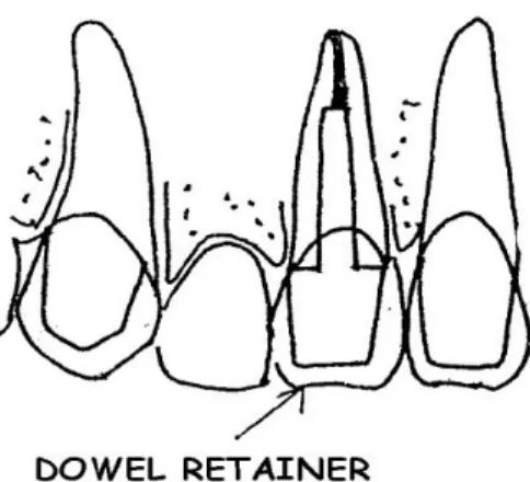 Gambar 9: Dowel Retainer