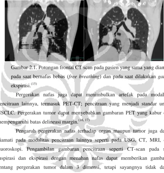 Gambar 2.1. Potongan frontal CT scan pada pasien yang sama yang diambil  pada  saat  bernafas  bebas  (free  breathing)  dan  pada  saat  dilakukan  gating  ekspirasi