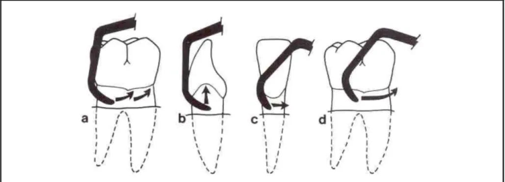 Gambar 6.  Arah sapuan pada waktu instrumentasi. A. Oblik; B. Vertikal; C. Horizontal; D