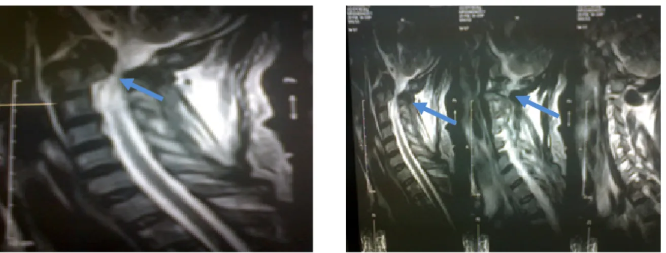 Gambar 2. MRI Cervical