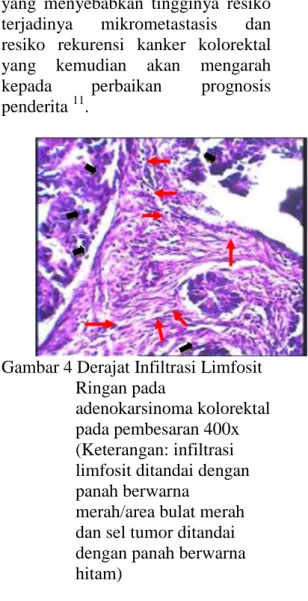 Gambar 4 Derajat Infiltrasi Limfosit  Ringan pada 