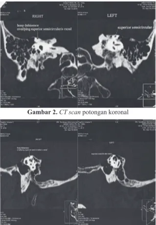 Gambar 2. CT scan potongan koronal  