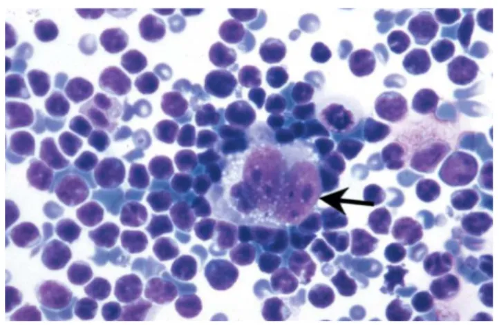Gambar 4. Limfoma Hodgkin. Tampak sel Reed Sternberg  klasik dengan atar belakang limfosit dan eosinofil