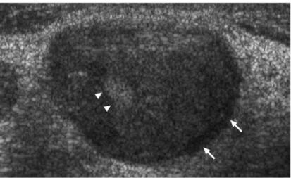 Gambar 6.  Gray-scale sonogram metastasis  pada KGB. Tampak  adanya hypoechoic, round, tanpa echogenic hilus (tanda panah)