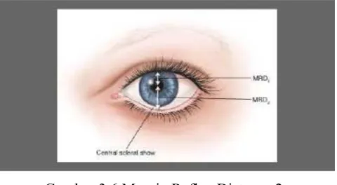 Gambar 3.6 Margin Reflex Distance 2.