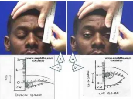 Gambar 3.8 Pemeriksaan Levator Function 5. Bells Phenomenon