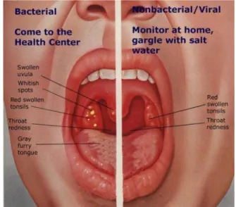 Gambar 2. Tonsilitis 