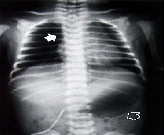 FIGURE 1. Posteroanterior chest radiograph taken at 10 hours of life in a neonate with  suspected esophageal atresia