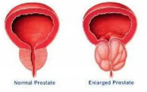 Gambar 7. el pada Prostat &lt;ormal dan Prostat yang Membesar 