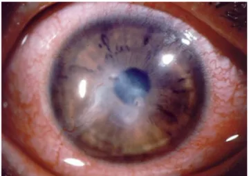 Gambar 10. Keratitis rosasea