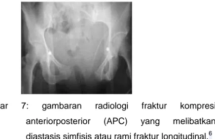Gambar  7:  gambaran  radiologi  fraktur  kompresi    anteriorposterior  (APC)  yang  melibatkan  diastasis simfisis atau rami fraktur longitudinal