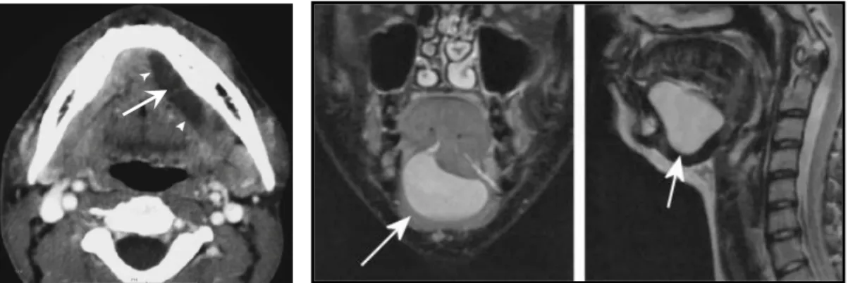 Gambar 2.12   Gambaran radiografi                            ranula (CT Scan),                            ditunjukkan oleh                            tanda panah 4