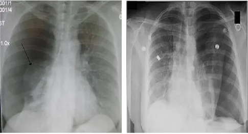 Foto Rö pneumotoraks (PA), bagian yang ditunjukkan dengan  anak panah merupakan bagian paru yang kolaps