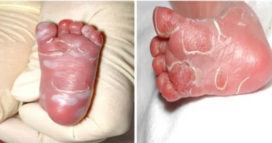 Gambar 3. Sifilis kongenital pada telapak kaki bayi