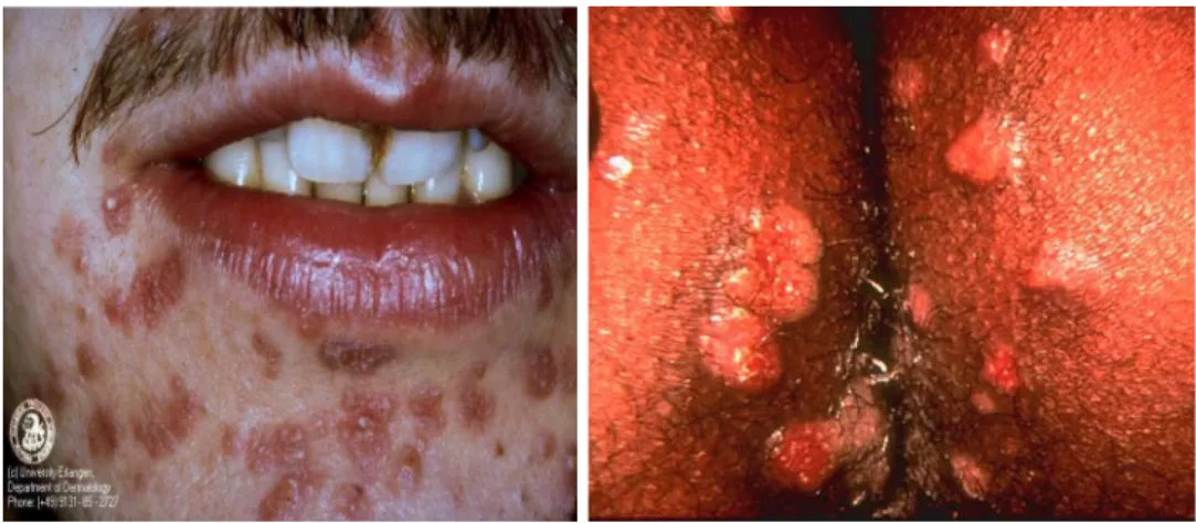 Gambar 2. Sifilis sekunder di daerah sekitar mulut dan genital