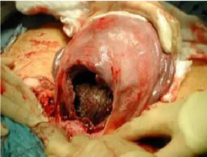 Gambar mioma uteri