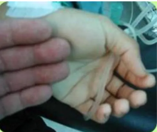 Gambar 2.Perbandingan telapak tangan pasien syok dengan pemeriksa 