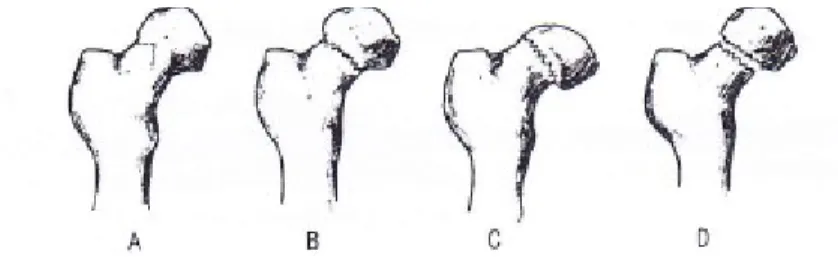 Gambar 4.1 Klasifikasi fraktur collum femur menurut Garden 2 A. Stadium I C. Stadium III