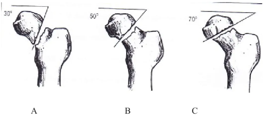 Gambar 4.2 Klasifikasi fraktur collum femur menurut Pauwel 2 A. Tipe I  B. Tipe II C. Tipe III