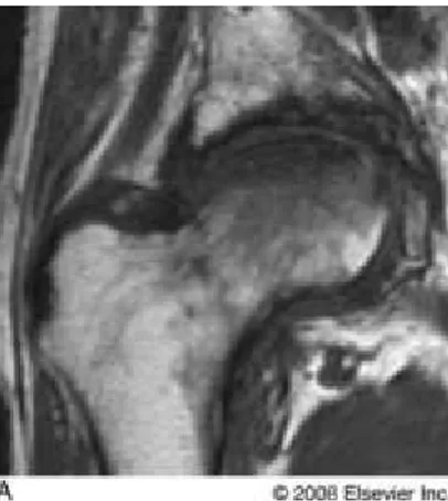 Gambar 5.2. MRI, kepala femur tampak pipih yang disebabkan  fraktur kompresi.