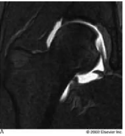 Gambar 5.4. MR Artografi pada proximal femur
