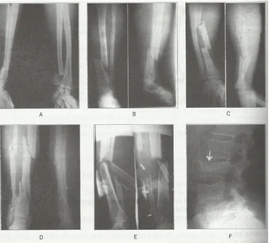 Gambar 2.3. Beberapa gambaran radiologik konfigurasi fraktur
