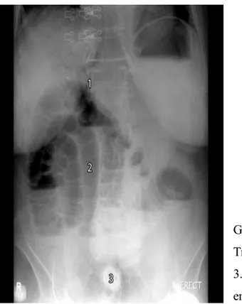 Gambar 7. Ileus obstruktif yang disebabkan oleh massa tumor extraintestinal