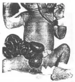 Gambar 1 . Gastroschisis