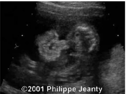 Gambar 2. USG Gastroschisis