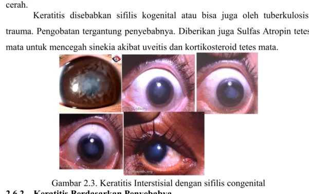 Gambar 2.3. Keratitis Interstisial dengan sifilis congenital 2.6.2 Keratitis Berdasarkan Penyebabya 