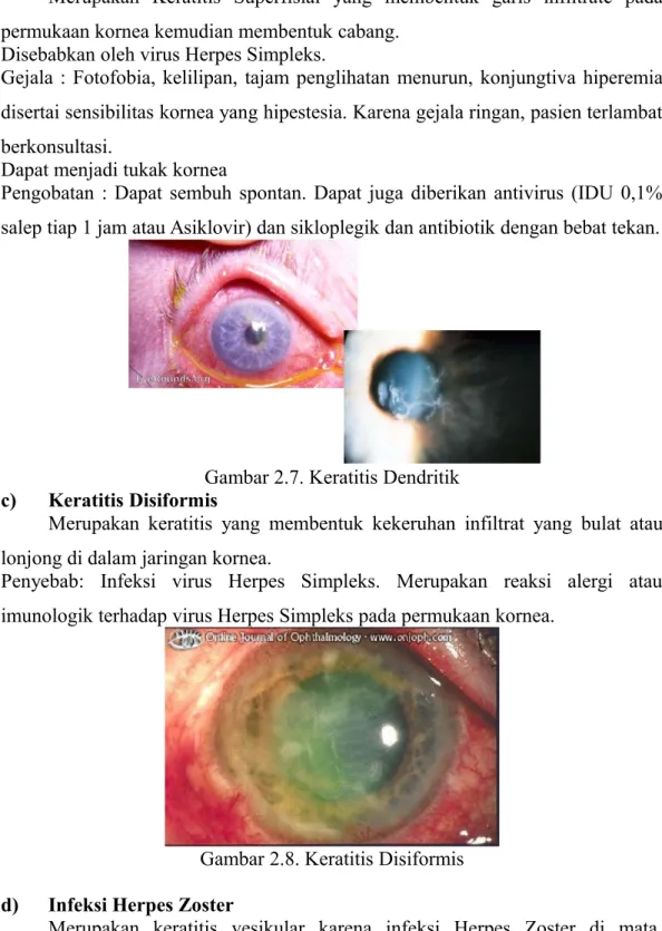 Gambar 2.7. Keratitis Dendritik c) Keratitis Disiformis
