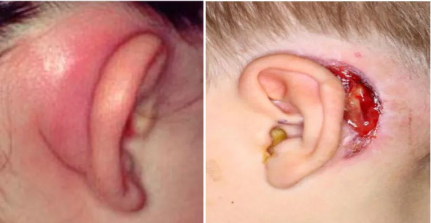 Gambar  . Mastoiditis akut dan mastoiditis kronik 