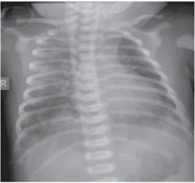 Gambar 11. Transient tachypnoea of the newborn dengan gambaran cairan pada fisura  transversalis dan hiperekspansi paru.