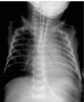 Gambar 3. HMD dengan granular appearance pada kedua paru