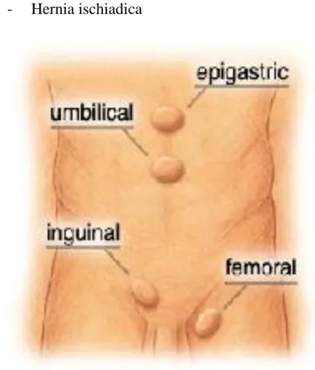 Gambar 3. Hernia eksterna 