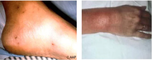 Gambar 2 : (kiri)Gonokokal infeksi pada pasien usia muda dengan gambaran septic arthritis pada ankle  kiri, tampak gambaran petecie, odema, (Kanan) septic arthritis pada pergelangan tangan
