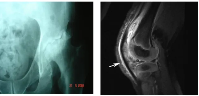 Gambar 3. (kiri): Foto pelvis AP Tampak proses destruksi pada permukaan sendi hip kiri