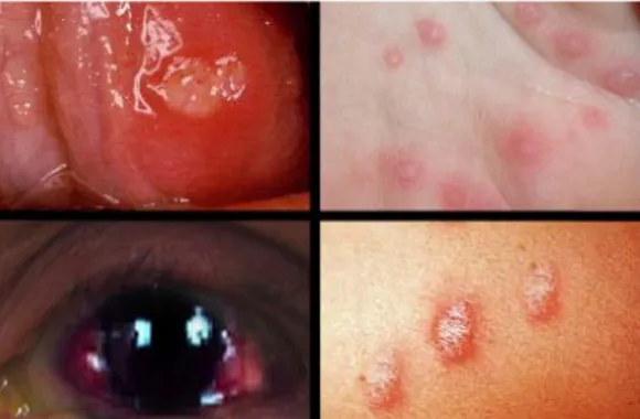 Gambar 3.6 Behcet’s Disease memiliki lesi ulser di mukosa mulut, mata, dan genital