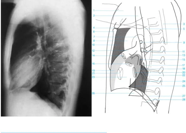 Gambar 6 dan 7: Gambar Radiograph Dada Lateral  5