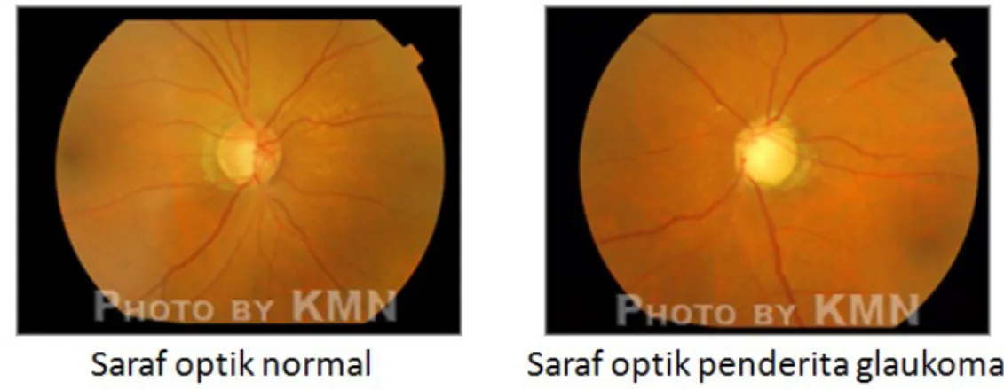 Gambar 2.12. Saraf Optik pada Orang Normal dan Penderita Glaukoma