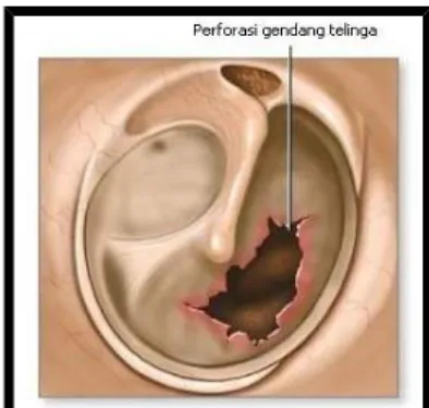Gambar 3.3. Perforasi Membran Timpani. 8