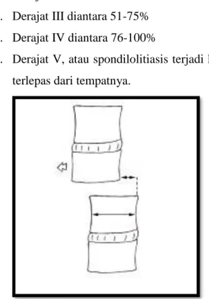 Gambar 1. Pengukuran Derajat Spondilolisthesis 