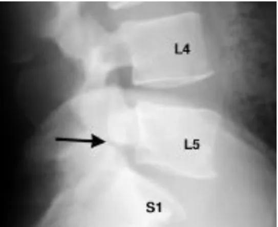 Gambar 3. Spondilolisthesis Traumatik Grade IV. 